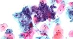 Deciphering a smear for cytology of the cervix